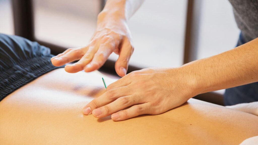 Tratamiento de Acupuntura